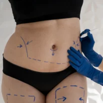 Mesoterapia